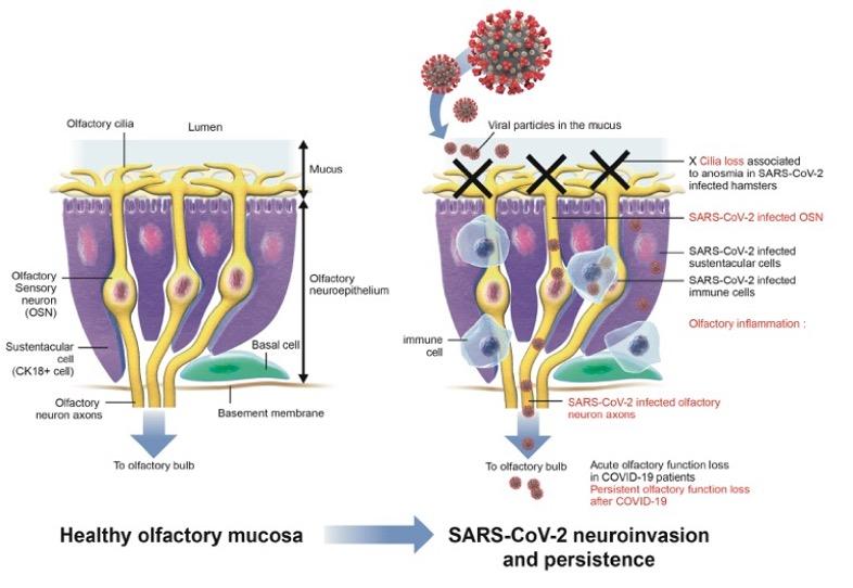 Olfactory dysfunction in COVID-19: pathology and long-term