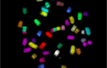 Chromosomes métaphasiques d’une cellule lymphoïde cancéreuse 